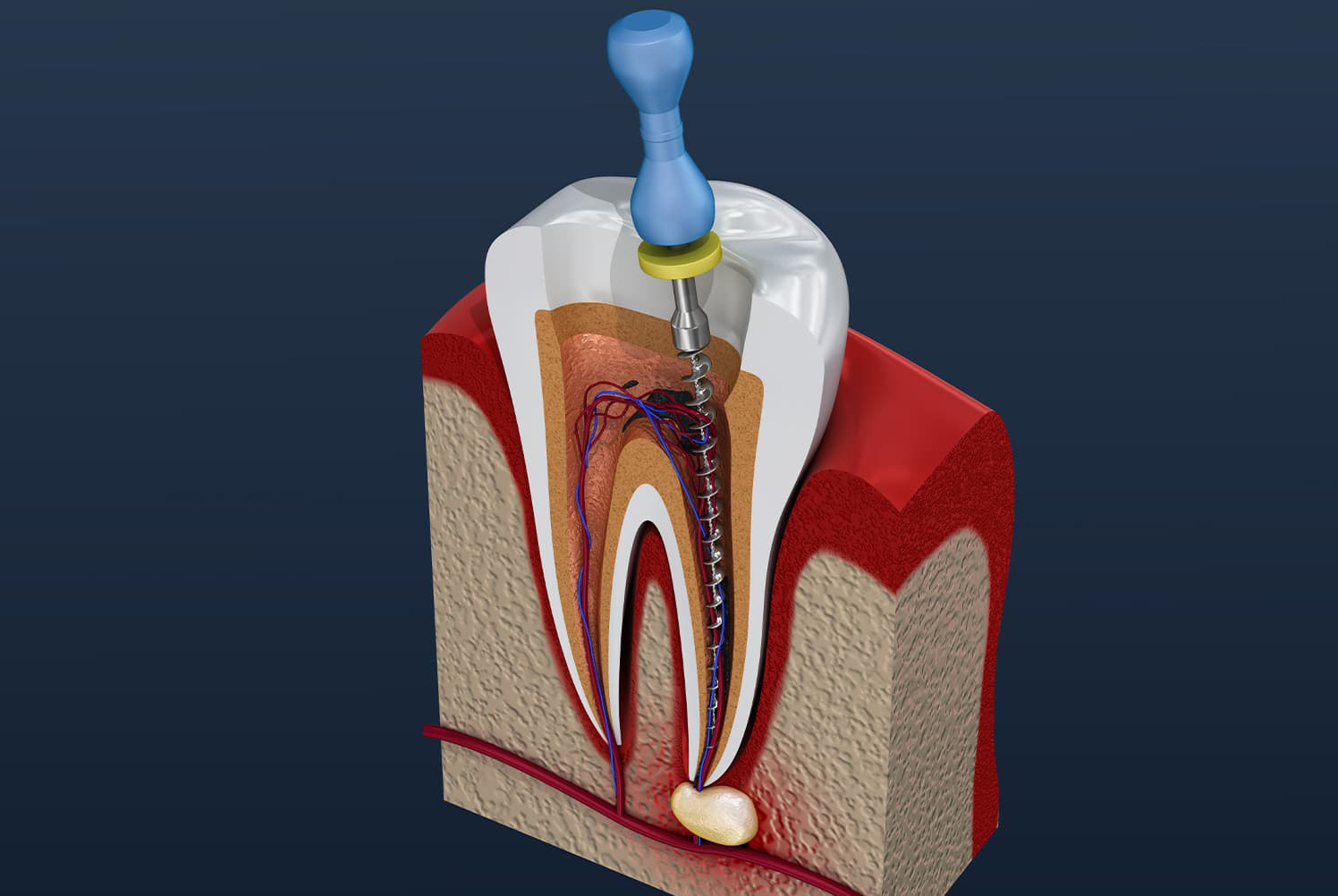 https://proyectoaurea.com/wp-content/uploads/2023/01/root-canal-treatment-2.jpg